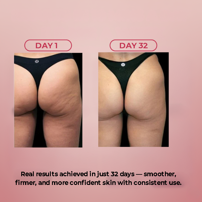 Celuvia™ Cellulite Massager